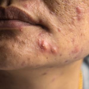 Cystic Acne: Identification, Causes, And More | atelier-yuwa.ciao.jp