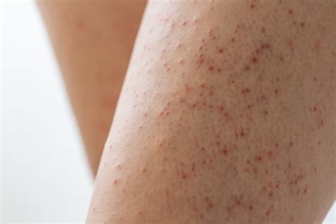 Understanding and Treating Keratosis Pilaris: Achieving Smoother Skin - Breaking Latest News