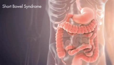 About Short Bowel Syndrome – Short Bowel Foundation