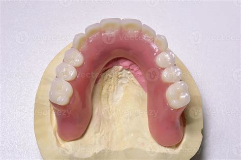 Dental prosthesis 953744 Stock Photo at Vecteezy