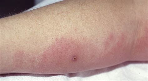 Erysipelas Vs Cellulitis Vs Impetigo