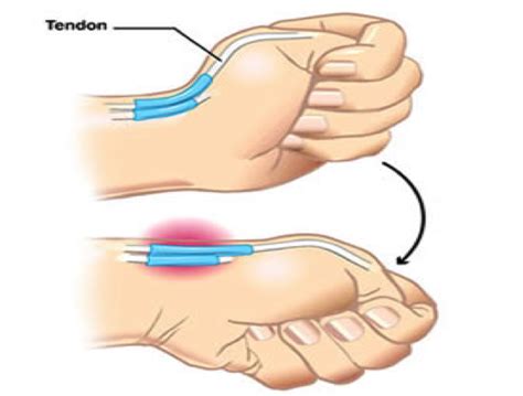 De Quervain syndrome - exercises for recovery - Body Organics