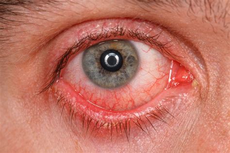 Inflammatory Eye Disease – AZIV Infusion Therapy Center