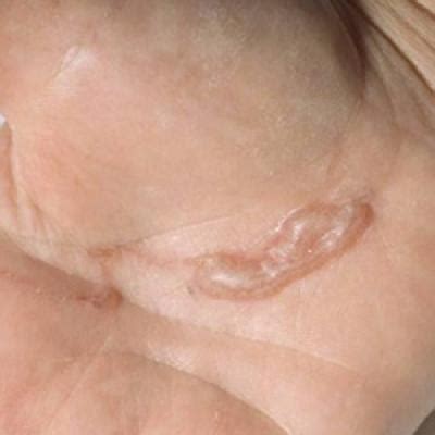 What’s Eating You? Cutaneous Larva Migrans | MDedge Dermatology