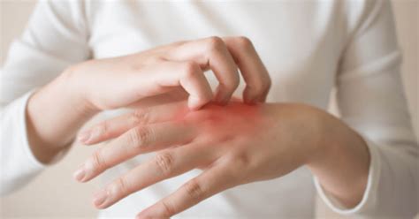 Nummular Eczema: Causes, Symptoms, and Diagnosis?