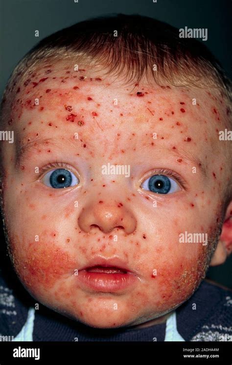 Chickenpox and eczema. Chickenpox and atopic eczema on the face of a five-month-old baby ...