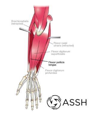 Flexor Tendon Injury – Carolyn Yang, MD