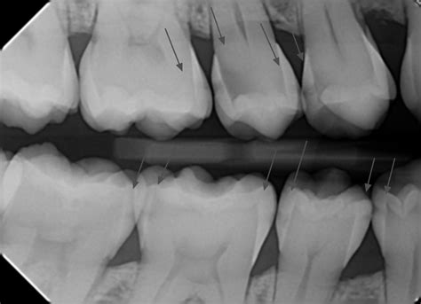 Bitewing xray with cavities 2 • Knoxville Family Dentistry