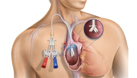 The Pristine™ Long-Term Hemodialysis Catheter: Physicians’ Perspectives - Endovascular Today