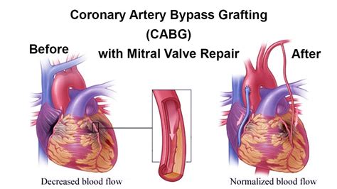 Coronary Artery Bypass Grafting in Nashik | Dr. Rahul Kaiche | Bypass Surgery in Nashik | Dr ...