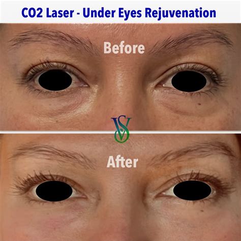 Co2 Laser For Under Eye Bags - Cosmetic Surgery Tips