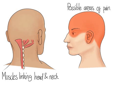 Cervicogenic Headaches - Beth Forrest Osteopathy