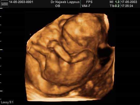 3D Second Trimester Ultrasound Scan Photos-second part of pregnancy | Dr N Layyous