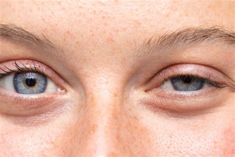 Painful Bump on Eyelid: Causes & Treatment | MyVision.org