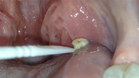 Digging Out a Large, Smelly Tonsil Stone - YouTube