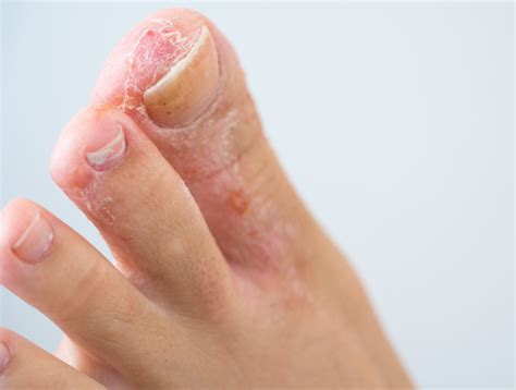 Why Do My Feet Feel Like They’re on Fire? – My FootDr