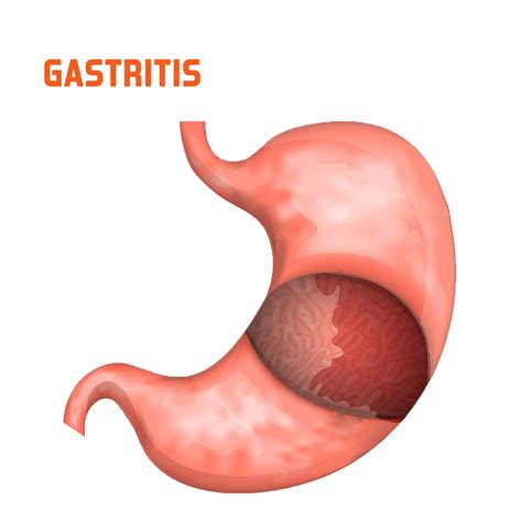 Gastritis - Gambaran
