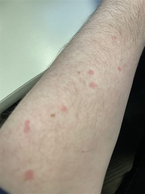 Red spots on arm : r/medical