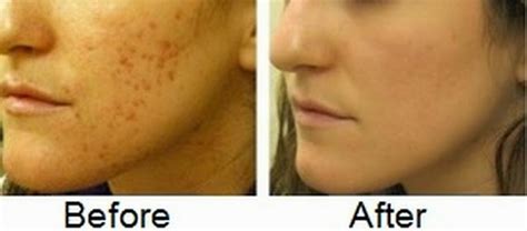 Health Care Tips: Know How to Remove Acne Scars – Get Rid of Pimple Scars on Face