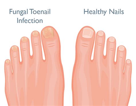 5 Healthy Habits to Prevent Toenail Fungus: Paul Betschart, DPM: Podiatrist