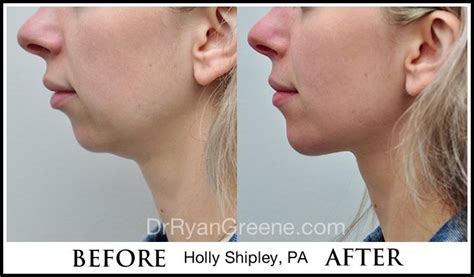 Chin augmentation and profile enhancement with Juvederm Voluma. Non-invasive filler treatments ...