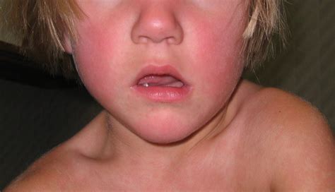 Derm Dx: Malar rash on the cheeks - Clinical Advisor