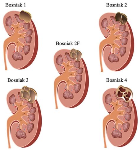 Cancers | Free Full-Text | Contrast-Enhanced Ultrasound (CEUS) for Follow-Up of Bosniak 2F ...