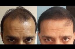 Biofibre Hair Transplant in Islamabad, Rawalpindi & Pakistan | Cost