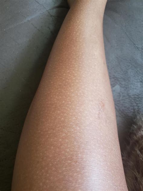 Help! Tiny white spots on arm and legs | Skin Care Talk