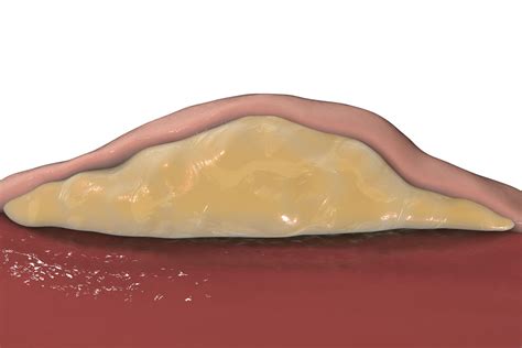 Lipoma Diagram