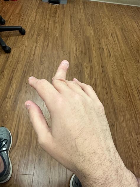 I managed to dislocate my finger in 2 directions at once : r/Wellthatsucks