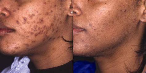 Hydroquinone Before And After Black Skin