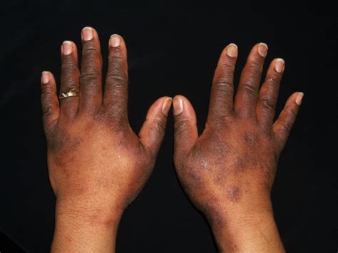 What causes eczema to flare-up - spacespassa