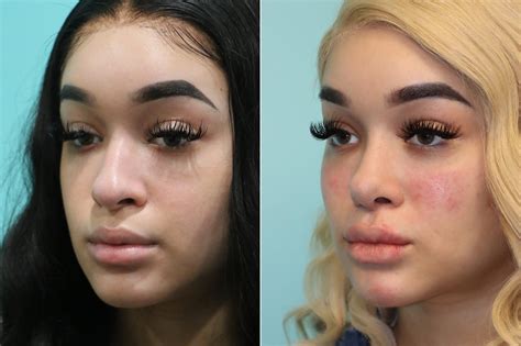 Cheeks / Midface Injections, Rhinoplasty photos | Chevy Chase, MD | Patient 19620