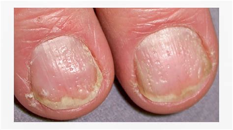 Pin on common nail disorders and diseases