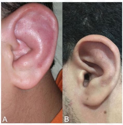 Limited auricular relapsing polychondritis in a child treated successfully with infliximab | BMJ ...
