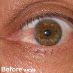 Pterygium Surgery Before & After Photos Monterey Park