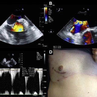 (PDF) Minimally Invasive Repair of Partial Atrioventricular Canal Defect