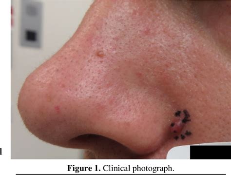 Figure 2 from A fibrous papule with abundant CD34-immunoreactive ...