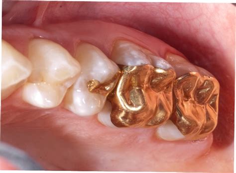 Gold Inlays, Gold Onlays and Gold Crowns | Portland, OR | Haven Dental PDX