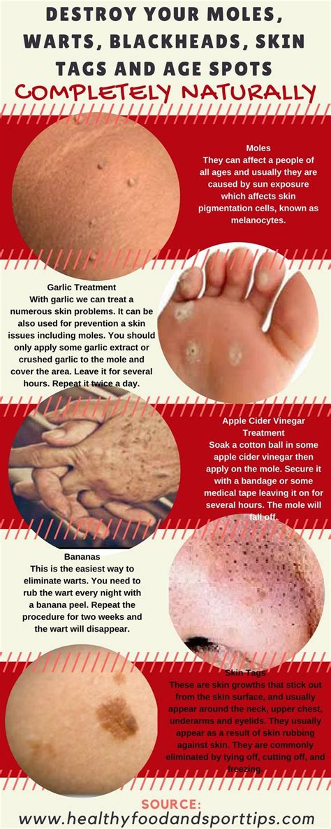 Destroy Your Moles, Warts, Blackheads, Skin Tags and Age Spots Completely Naturally!! | Warts ...