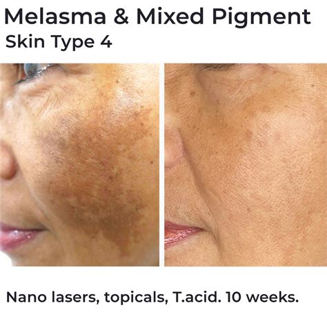 Best Melasma Treatment Packages Brisbane Cutis Dermatology