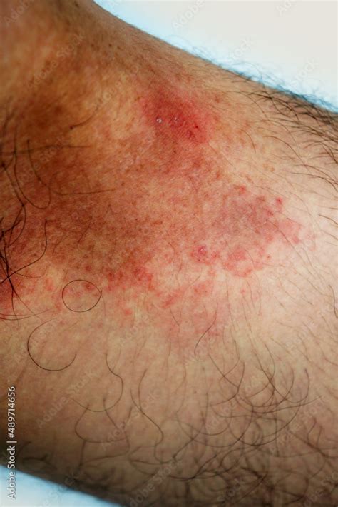 Itchy rash in the groin area. Tinea Cruris is a type of skin disease that occurs in the groin ...