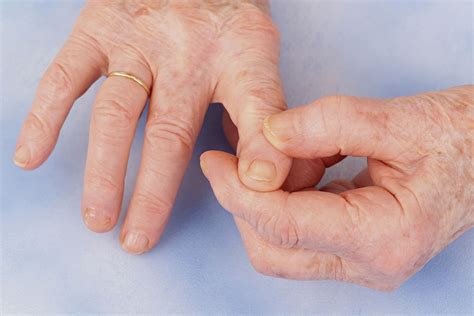 Early Osteoarthritis Hands