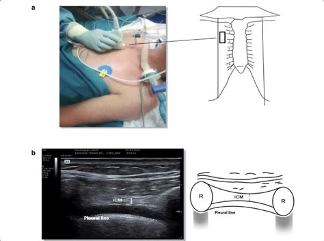 Intercostal muscle ultrasound. The figure depicts an ultrasound image ...