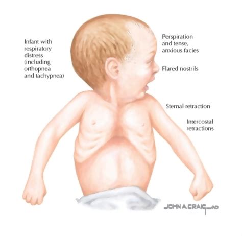 Clinical Characteristics of Too Much Pulmonary Flow (Pulmonary Volume ...