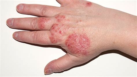 Eczema Allergic: Allergy, Asthma, and Sinus Relief | Expert Tips and Treatments