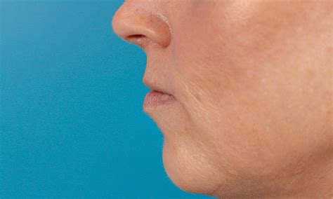 Lip Filler Before and After 02 | Dr. Ashlin Alexander