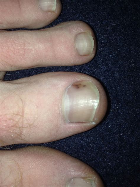 What Causes Black Spots On Fingernails - Design Talk