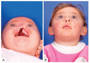 RBCP - Assessment of nasal anthropometric parameters after primary cleft lip repair using the ...